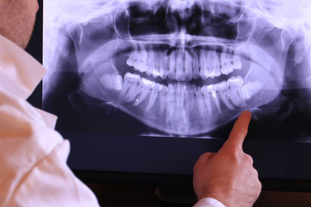 Best Root Canal Emergency Dentist  in Clover Creek, WA